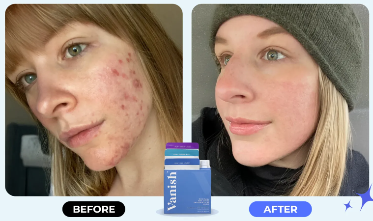 Vanish DrySerum customer Reviews