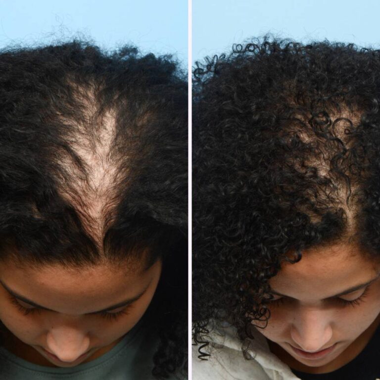 hair-growth-before-after-