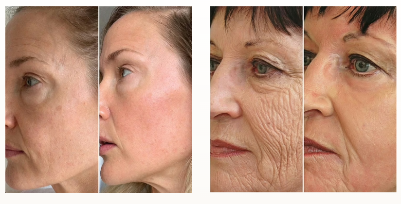 GloraMD Face Lift Serum customer results