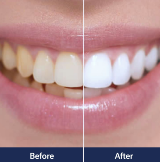 WellaWhite Teeth Whitening Kit Benefits