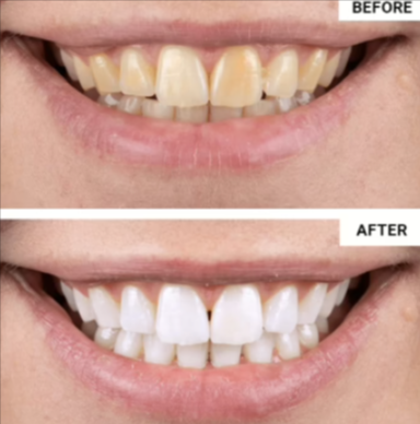 WellaWhite Teeth Whitening Kit cus 1