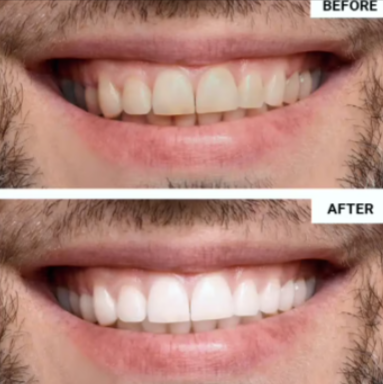 WellaWhite Teeth Whitening Kit cus 2