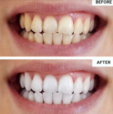 WellaWhite Teeth Whitening Kit cus 3